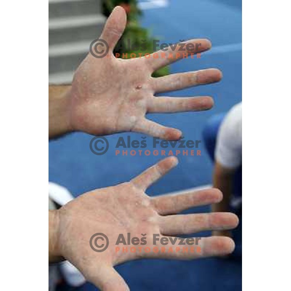 Edi Kolar\'s hands full of blisters 